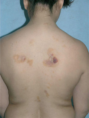 Máculas y pápulas confluyentes en placas, con marcada discromía (coloración marrón-amarillenta, color piel y eritematopurpúrica) y morfología variada, situadas en la espalda de la paciente.