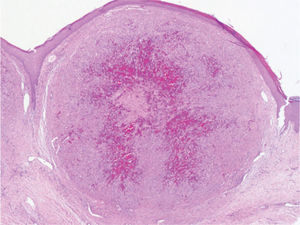 Lesión tumoral compuesta por una red de espacios vasculares con proliferación de células fusiformes (hematoxilina-eosina ×20).