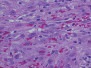 Detalle de la proliferación vascular con presencia de globos hialinos (hematoxilina-eosina ×400).