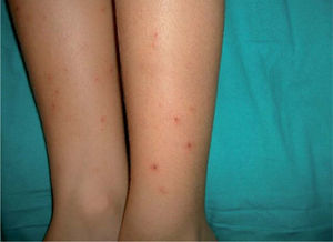 Niño de 8 años con múltiples picaduras excoriadas en las piernas provocadas por mosquito tigre.