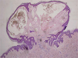 Epidermis acantósica con hiperqueratosis y papilomatosis; grandes estructuras vasculares dilatadas en la dermis superficial. Hematoxilina-eosina, ×10.