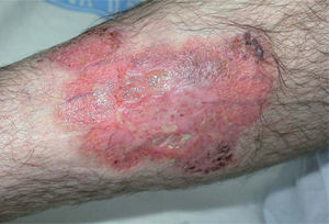 Caso 1. Lesiones en las piernas con evolución hacia úlceras de fondo irregular y bordes violáceos.