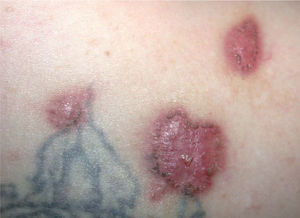 Caso 2. Cicatrices mamelonadas residuales en la espalda.