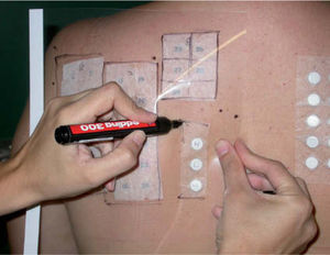 Localización de las pruebas de contacto en la espalda del paciente sobre la transparencia mediante el calcado con rotulador. Obsérvense los puntos de referencia.