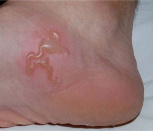 Lesión serpenteante con pápulas y vesículo-ampollas localizada en la cara laterointerna del pie derecho.