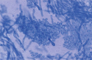 Examen directo de pitiriasis versicolor en KOH + tinta, ×1.000.
