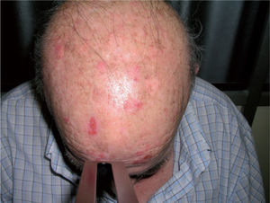 Paciente remitido para tratamiento de múltiples queratosis actínicas en cuero cabelludo.