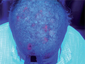 Imagen de fluorescencia. Se aprecia cómo la fluorescencia se limita a menos de un 30 % del área a tratar, que es todo el cuero cabelludo en su porción superior.