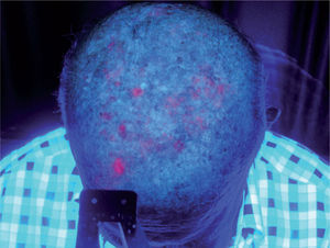 Imagen de fluorescencia previa a la segunda sesión. La fluorescencia continúa situándose en menos del 30 % del área a tratar, por tanto, no se aprecia disminución de la fluorescencia tras la primera sesión.
