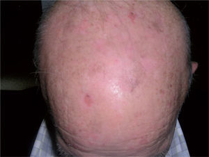 Revisión del paciente a los 3 meses de la segunda sesión. Se aprecia disminución de más del 50 % de las queratosis actínicas, por tanto, se clasifica como respuesta completa.