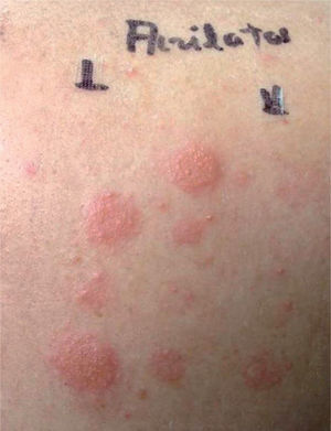 Pruebas epicutáneas con la batería de acrilatos con positividad a varios alergenos.