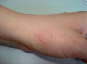 Lesiones en el dorso de la mano por apoyo en la mesa de trabajo.