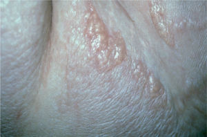 Lesiones ampollosas en la parte inferior del abdomen
