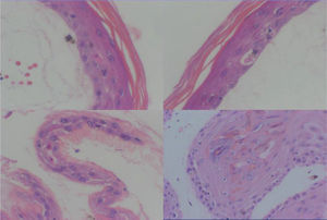 La epidermis presenta queratinocitos necróticos, pero sin necrosis celular satélite, característica de la enfermedad injerto contra huésped, y también afectación de los ductos ecrinos con cambios similares a los observados en la epidermis. Hematoxilina-eosina x20.