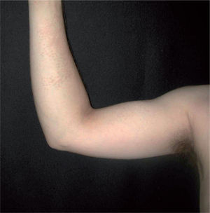 Lesiones de morfea en gotas en el antebrazo y la cara interna del brazo derecho. Se aprecia la confluencia de éstas en el antebrazo.