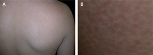 A. Lesiones de morfea en gotas en la espalda. B. Piel de la espalda a mayor aumento (las lesiones de morfea en gotas son las pequeñas placas marrones levemente deprimidas).
