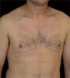 Lesiones de morfea en gotas en el tronco anterior. A nivel pectoral derecho se aprecian dos placas blanquecinas sugestivas de liquen escleroso y atrófico.