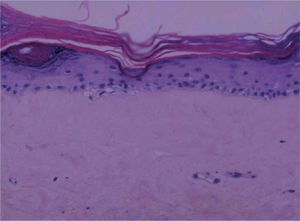 Biopsia de la lesión pectoral derecha. Se aprecia hiperqueratosis, atrofia epidérmica, hialinización de la dermis papilar y vacuolización focal de la basal (hematoxilina-eosina, ×400).