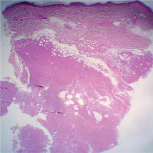 Infiltrado tumoral nodular hipodérmico linfoplasmocitoide (hematoxilina-eosina, ×20).