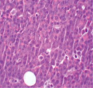 Linfocitos B de citoplasma amplio, eosinófilo y núcleo excéntrico con nucléolo prominente (hematoxilina-eosina, ×200).