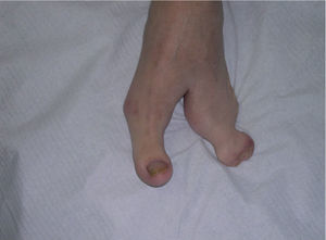 Malformaciones en los pies en «tenaza de langosta».