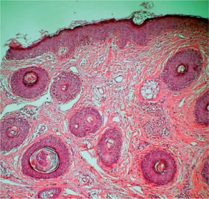 Estudio histopatológico de una lesión papulosa en la que se pone de manifiesto la presencia de telangiectasias junto con una llamativa fibrosis concéntrica perivascular y perifolicular (hematoxilina-eosina, ×40).