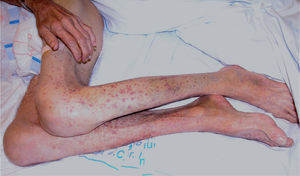 Nuestro paciente mostraba lesiones purpúricas extensas, hiperqueratosis folicular y pelos enroscados.