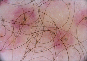 La imagen dermatoscópica mostraba, además de los pelos «en sacacorcho», un halo anaranjado pálido perifolicular por fuera del cual se distribuían las lesiones purpúricas.