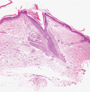 En el estudio histopatológico se observaba una fibrosis perifolicular. Los hematíes extravasados se disponían fuera de la misma, en zonas donde la dermis era más laxa. Obsérvese el tallo piloso seccionado a distintos niveles en el interior del folículo (hematoxilina-eosina, ×40).
