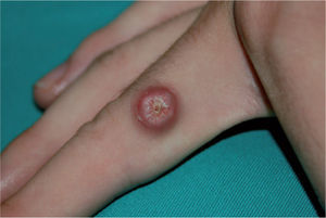 Nódulo de superficie crateriforme en el dedo.