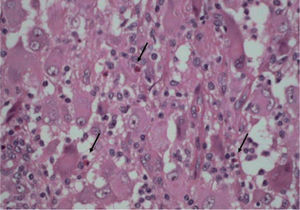 Células histiocíticas de citoplasma abundante en vidrio esmerilado y algunos eosinófilos entremezclados (flechas). Hematoxilina-eosina, x100.