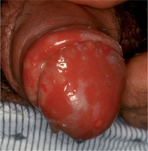 Primoinfección herpética en la que se aprecian múltiples erosiones con contornos policíclicos, rodeadas por un halo eritematoso, que generalmente asocian intenso dolor.