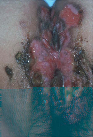 Herpes genital en una paciente con infección por el VIH. Las úlceras genitales en pacientes inmunodeprimidos suelen ser muy numerosas y pueden alcanzar tamaños enormes y asociarse con intenso dolor.