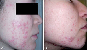 Acné persistente. Lesiones pápulo-nodulares en el tercio inferior de rostro y cuello.