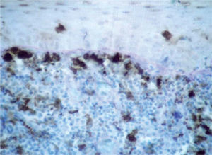 Factor XIIIa+ DD in the epithelium.