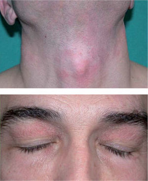 Dermatitis alérgica de contacto por Quaternium 15 que contenía un champú utilizado por el paciente.