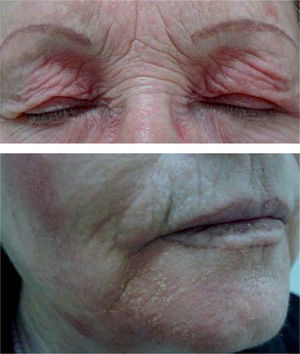 Eccema de contacto por laca de uñas debido a la resina de toluensulfonamida formaldehído. Se trata de una dermatitis de contacto aerotransportada, por eso afecta a los párpados, las mejillas y a la región perioral, pero no a los dedos.