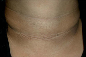 Acantosis nigricans y aumento de pelo terminal en la región cervical anterior justo encima de la prominencia laríngea.