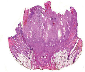 Lesión crateriforme con el centro ocupado por material queratósico y la base constituida por un epitelio escamoso hiperplásico donde se evidenciaba queratinización tricolémica. Eosina-hematoxilina, x10.