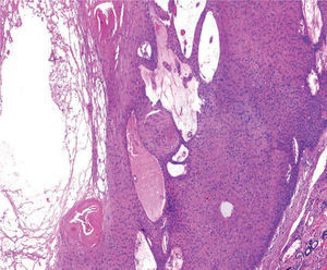 Detalle de la lesión: epitelio con una capa periférica de células cuboideas en empalizada, sobre una membrana basal, y varias capas suprayacentes constituidas por células escamosas grandes de citoplasma. Eosina-hematoxilina, x40.
