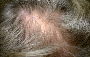 En la imagen clínica apenas se observan alteraciones. Discreto eritema en el cuero cabelludo.