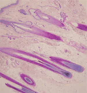 Biopsia del cuero cabelludo donde se observa un aumento del grosor del tejido celular subcutáneo que incluso se extiende hacia la dermis con morfología normal de los folículos pilosos y la epidermis (hematoxilina-eosina, ×4).