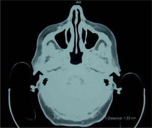 Tomografía computarizada que muestra el aumento del grosor del tejido celular subcutáneo del cuero cabelludo (1,52cm en el área occipital).