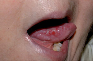 Ulceraciones de la mucosa oral (paciente del segundo caso).
