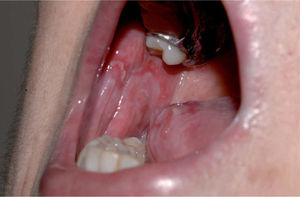 Detalle de las lesiones en la lengua (paciente del segundo caso).