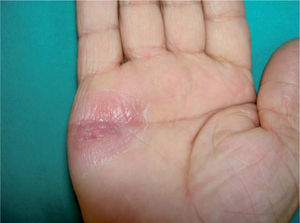 Lesión eritematosa residual reepitelizada tras tratamiento con amoxicilina-clavulánico.