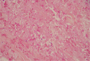 En la dermis se observan abundantes estructuras micóticas eosinófilas redondeadas u ovales de 4–7 micras, rodeadas del típico halo claro (hematoxilina-eosina, ×200).