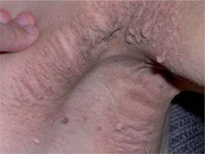 Área engrosada hiperpigmentada de superficie aterciopelada con multitud de fibromas blandos en superficie en la axila izquierda.
