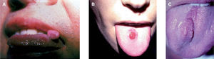 Aspecto clínico del tumor de células granulares cutáneo (TCG). A. Nódulo polipoide con aspecto de fibroma en el dorso de la lengua. B. Nódulo violáceo bien delimitado en el dorso lingual. C. Nódulo del color de la lengua mal delimitado.