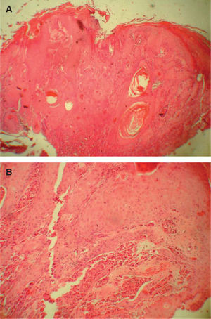 A. Hiperplasia seudoepiteliomatosa (HSE) simulando un carcinoma espinocelular (hematoxilina-eosina, ×10). B. Imagen en detalle de la HSE con las células granulares en dermis papilar (hematoxilina-eosina, ×200).